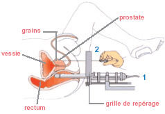 Curiethérapie prostate