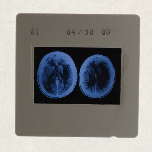 Diapositive Glioblastome
