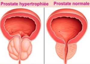 Hyperplasie bénigne de la prostate (HBP)