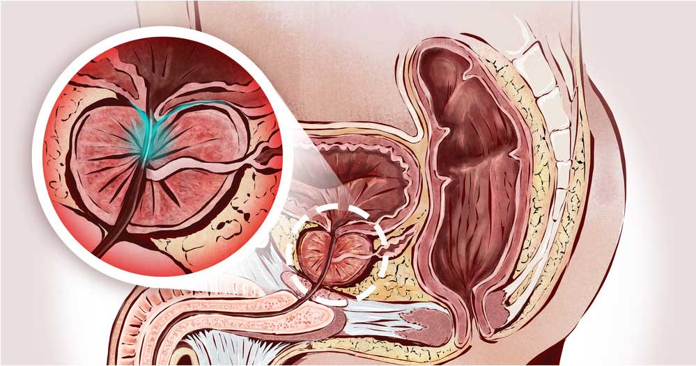 Tratamentul precoce a unei prostatite