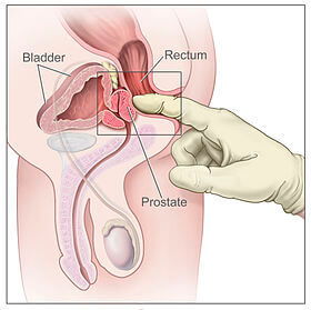 touché rectale prostate